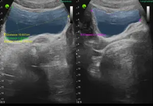 Gallery_Bladder-Measure_B-mode