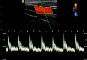 Gallery_Carotid_PW-mode