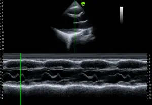 Gallery Parasternal Long Axis View (PLAX) M mode