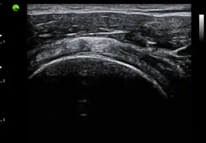 Gallery Subscapularis Tendon B mode