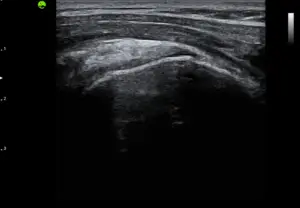 Gallery Supraspinatus Tendon B mode